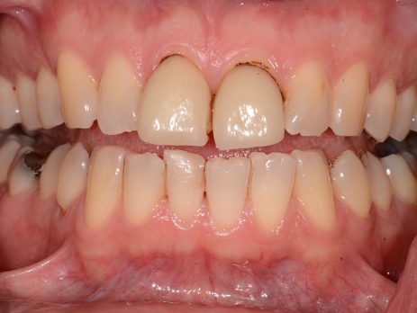 Felspathic veneer