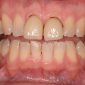 Felspathic veneer