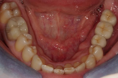 Implant Restorations