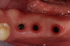 Implant