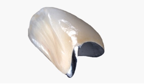 Porcelain fused metal dental crowns